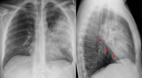 Рентгенография – распространенный метод диагностики пневмонии.