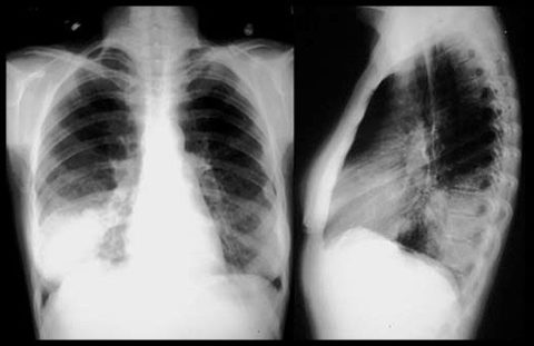 Рентгенография грудной клетки при этой форме заболевания проводится в двух проекциях