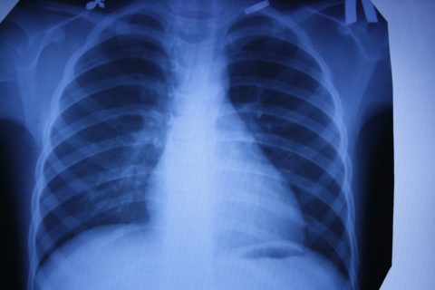 Рентгенография как простой и доступный метод диагностики.