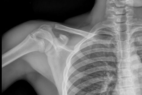 Рентгенограмма перелома шейки плеча