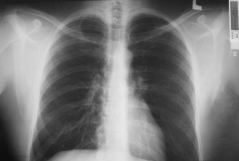 Рентгенограмма подтверждает наличие бронхита хронической формы