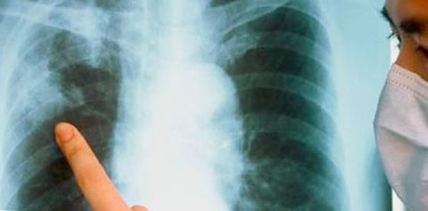 Рентгенограмма помогает выявить туберкулез на ранней стадии.