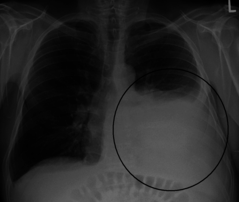 Рентгенограмма позволяет выявить наличие выпота в плевральной полости.