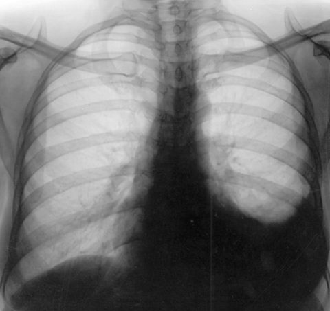 Рентгенологическая картина экссудата в плевральной полости слева