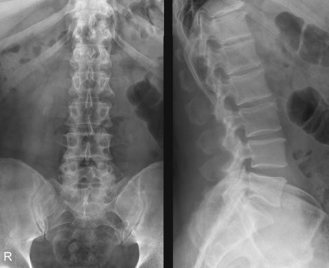 Рентгенологические снимки перелома позвонков