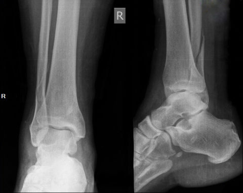 Рентгенологический снимок перелома со смещением