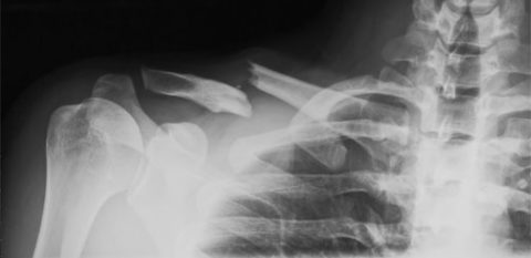 Рентгенологический снимок повреждения целостности кости ключицы
