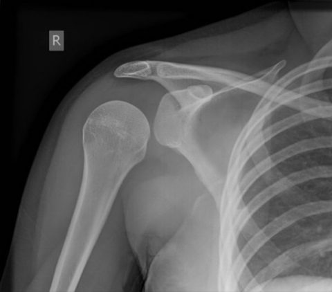 Рентгенологический снимок при травмах плеча