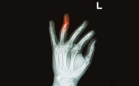 Рентгенологический снимок травмированного пальца верхней конечности