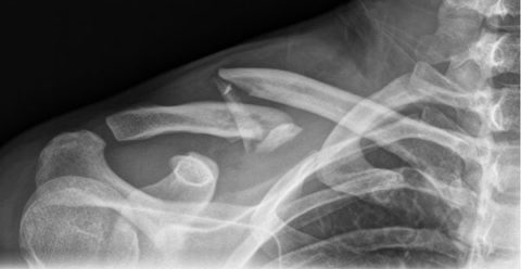 Рентгеновский снимок как диагностика при подозрении перелома ключицы у человека