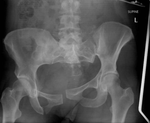 Рентгеновский снимок нарушенной целостности костей в области таза человека