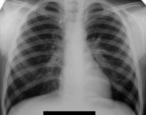 Рентгеновский снимок при бронхопневмонии