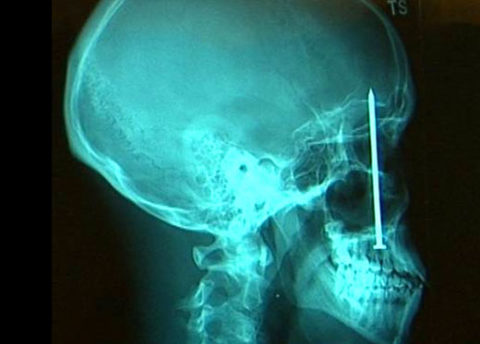 Рентгеновский снимок при дырчатом нарушении целостности костных структур черепа