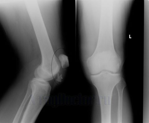 Рентгеновский снимок при нарушенной целостности структур коленного сустава