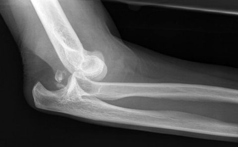 Рентгеновский снимок при сломанной руке в области локтевого сустава