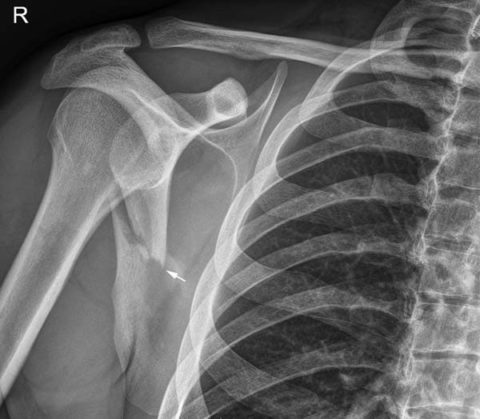 Рентгеновское исследование для диагностики перелома лопатки у человека