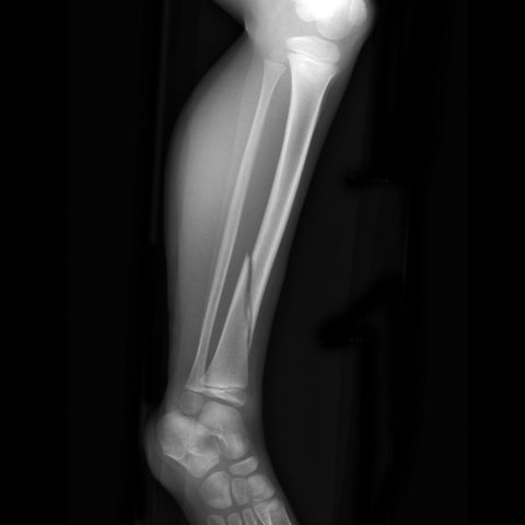 С помощью рентгена можно узнать какие переломы ноги бывают и их локализацию