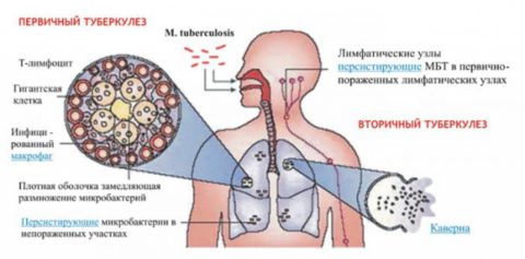 Схема распространения патологического процесса при первичном туберкулезе