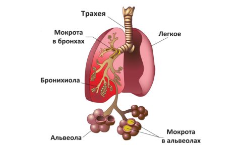 Схематическое изображение альвеол при пневмонии