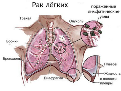 Схематическое изображение рака легких