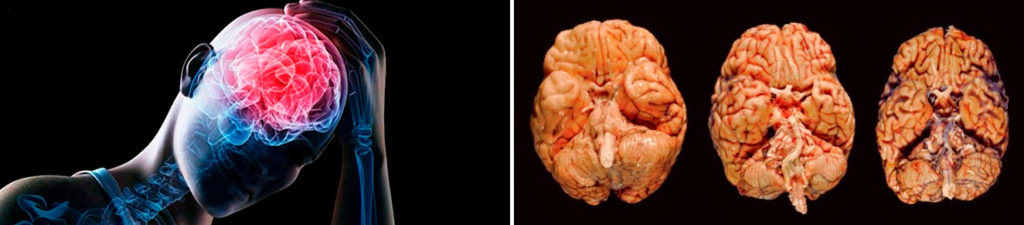 Сифилис головного мозга