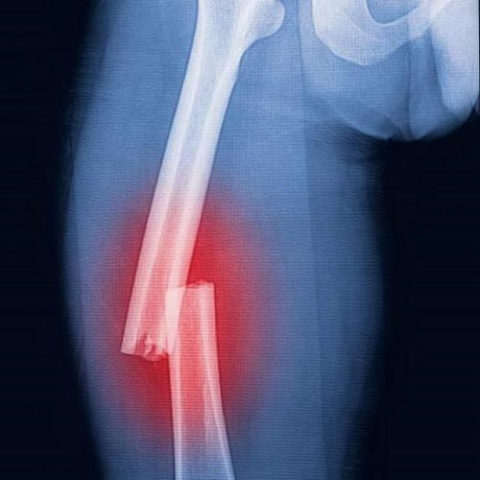 Смещение фрагментов кости как причина вынужденной формы ноги