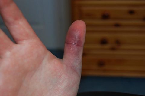 Способы определения типа повреждения пальца руки