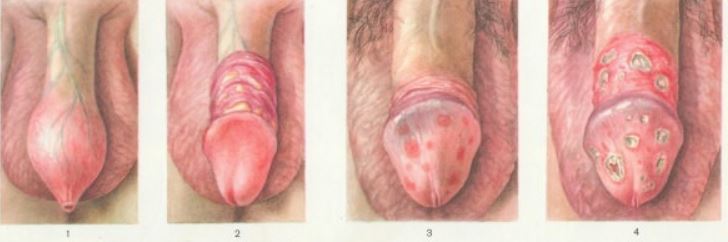 Сифилис на члене Сифилис половых органов на разных стадиях