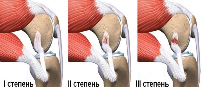 Разрыв связок сустава колена