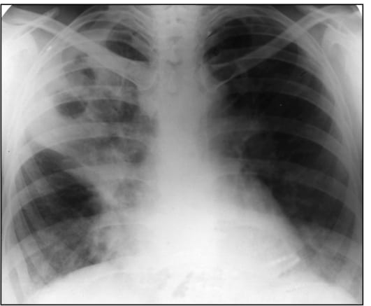 Своевременное и раннее выявление туберкулеза позволяют эффективно бороться с этой проблемой.