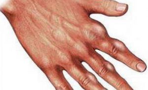 Болят суставы на пальцах рук