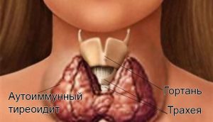 Щитовидная железа и заболевания суставов