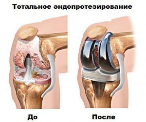 Как лечить боль в суставах колен?