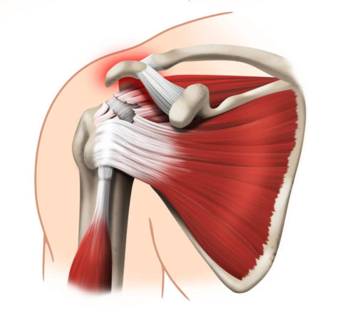 Травма нижних отделов плечевой структуры