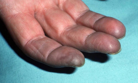 Цианоз пальцев руки