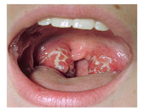 Туберкулез гортани, миндалин и горла – передается контактным путем через поцелуи