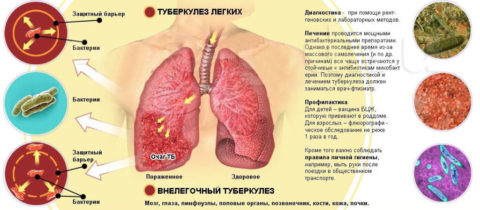 Туберкулёз поражает весь организм, а не только лёгкие