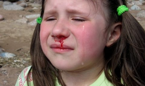 Травма носа: клиника перелома носа у детей, симптомы, диагностика, последствия не леченой травмы