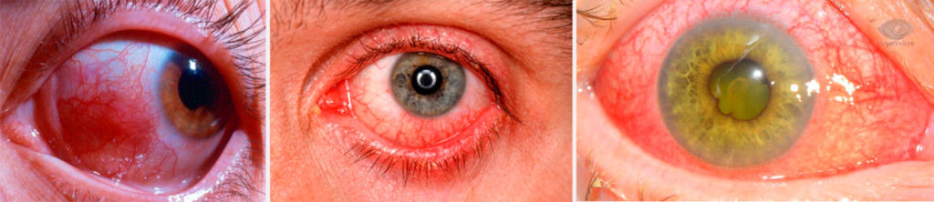 Глазной хламидиоз: как правильно выбрать глазные капли от хламидиоза?