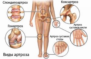 Причины и лечение артроза всех суставов