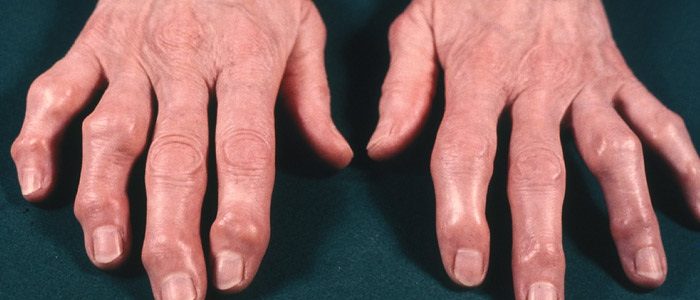 Деформация суставов пальцев на руках