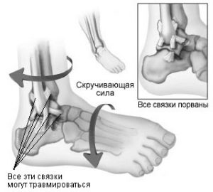 Надрыв сухожилия на ноге