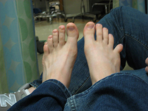 Визуальное определение травмы пальца на ноге