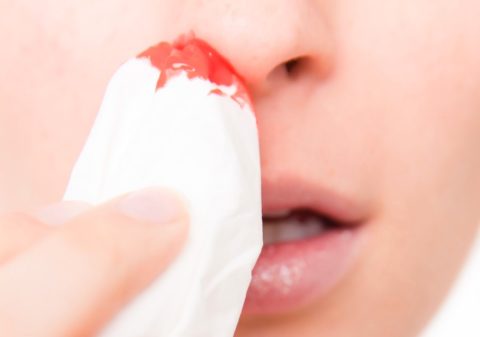 Влажные тампоны помогут остановить носовое кровотечение