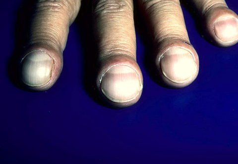 Внешний вид ногтей с симптомом часового стекла и пальцев по типу барабанных палочек