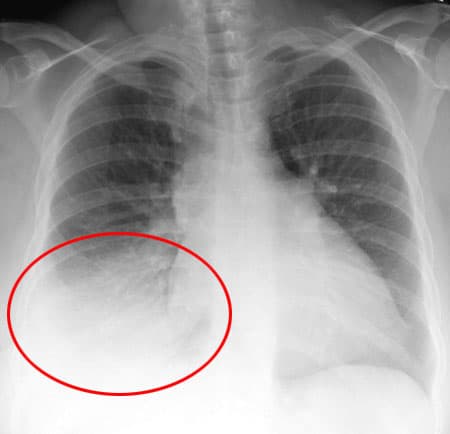 Воспаление легких: данные рентгенографии.