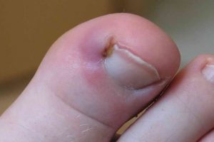 Боль в пальце на ноге