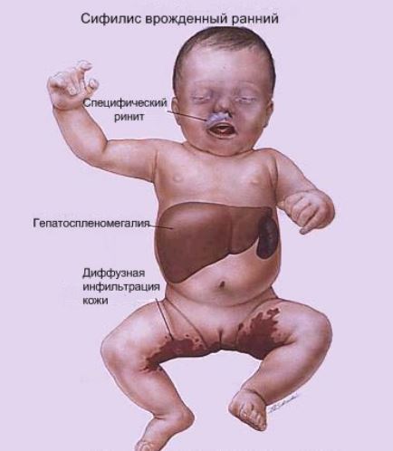 Сифилис у детей врожденный
