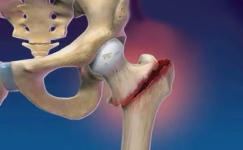 Высокоэнергетические причины получения перелома тазовых костей