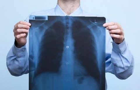 Выявление пневмонии при тяжелом бронхите на рентгенограмме